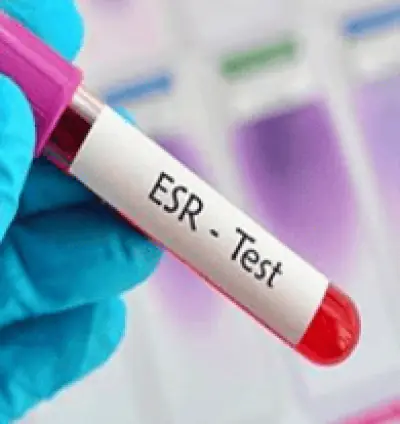 Erythrocyte sedimentation rate (ESR) blood test in Dera Baba Nanak | ESR Test | inflammation test